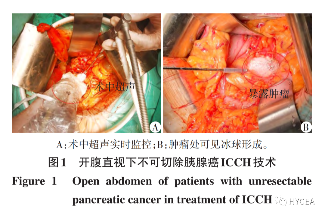 【科研资讯】术中冷冻消融和冷热复合消融医治不成切除胰腺癌的临床钻研